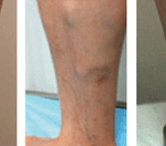 stage of varicous vein3 150x132 เมื่อไรต้องใส่ Jobst ulcercare ถุงน่องเส้นเลือดขอดสำหรับผู้มีแผลที่ขา