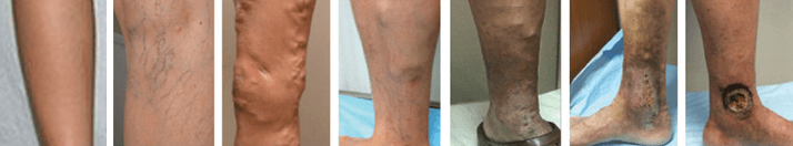 stage of varicous vein3 ปวดขา ขาหนักเมื่อย ขาบวม จากเส้นเลือดขอด