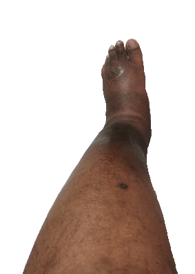 dv1 เมื่อไรต้องใส่ Jobst ulcercare ถุงน่องเส้นเลือดขอดสำหรับผู้มีแผลที่ขา