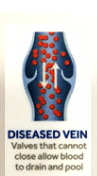 Diseased vein เส้นเลือดขอด varicose vein