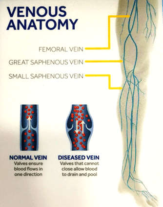 venous anatomy 1 เส้นเลือดขอด varicose vein