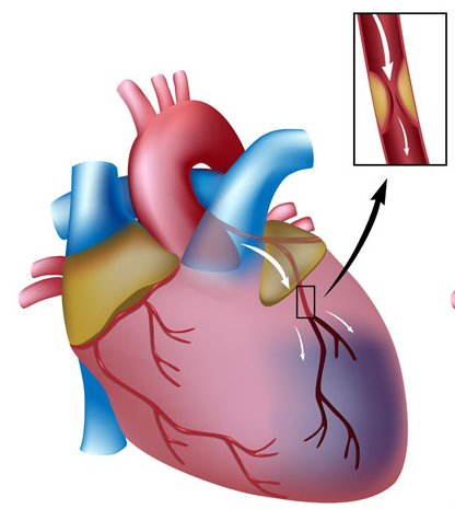 heart artery อันตรายจากไขมันในเลือดสูง
